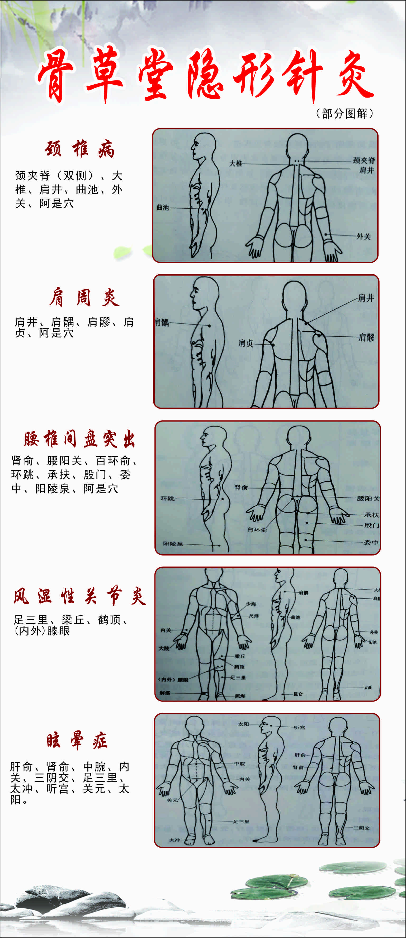 骨草堂隐形针灸
